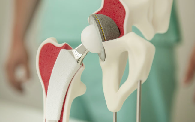 Schmerzen künstliche Gelenke | Orthopäde Wien 1180